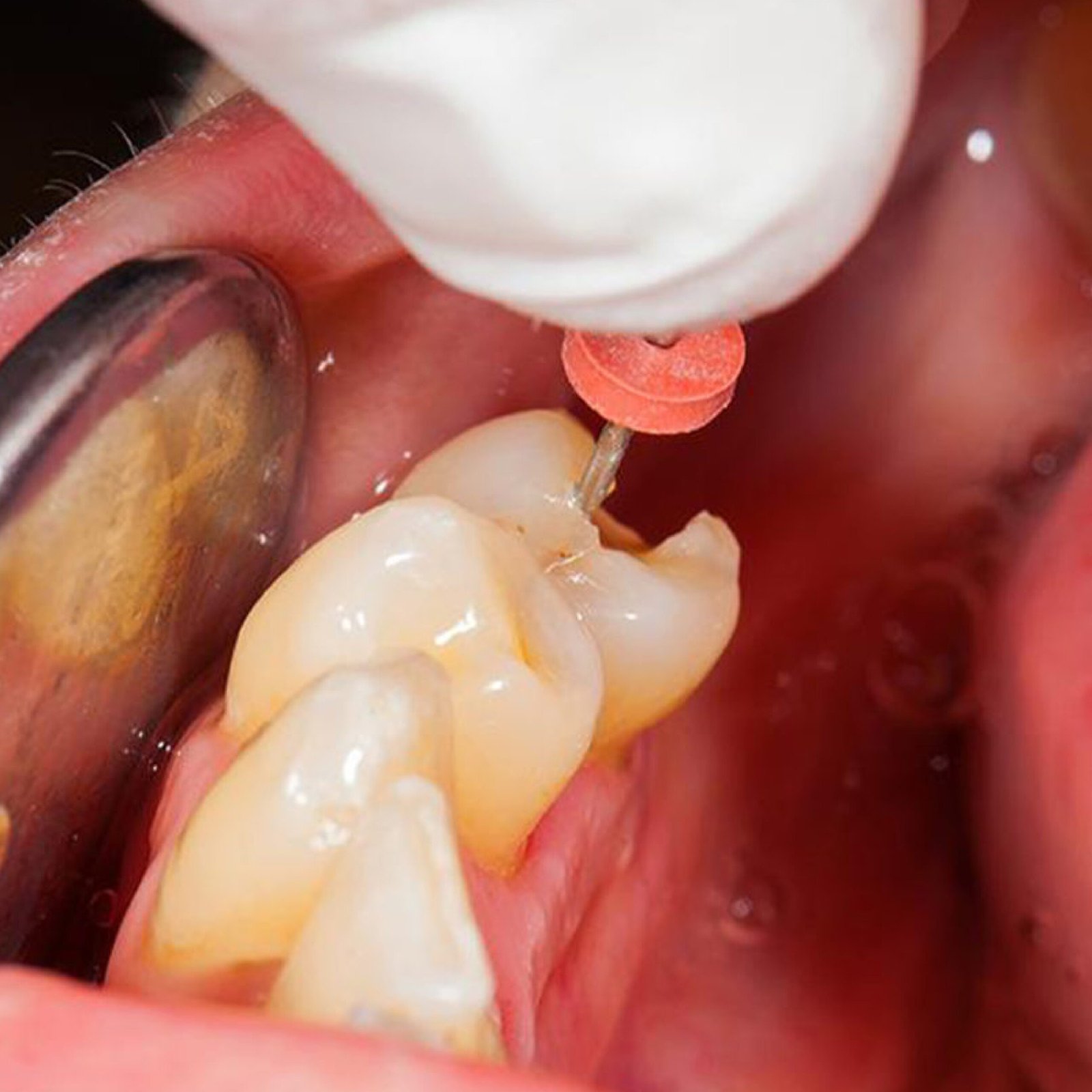 Endodoncia